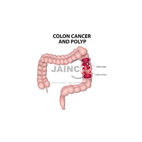 Colon Cancer and Polyp Model