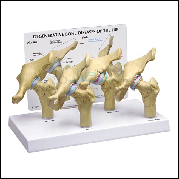 Hip Osteoarthritis Model