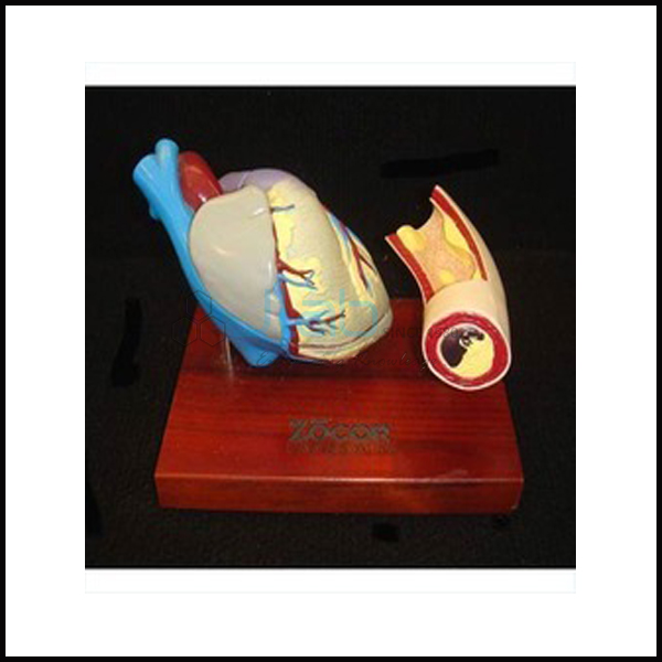 Heart With Artery Blockage Model