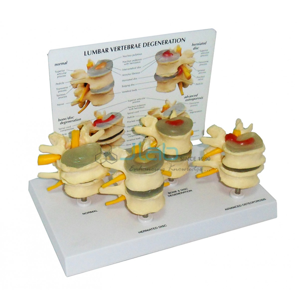 Four Stage of Vertebrae Disease