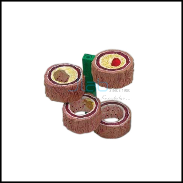 Artery Model Showing Plaque Building