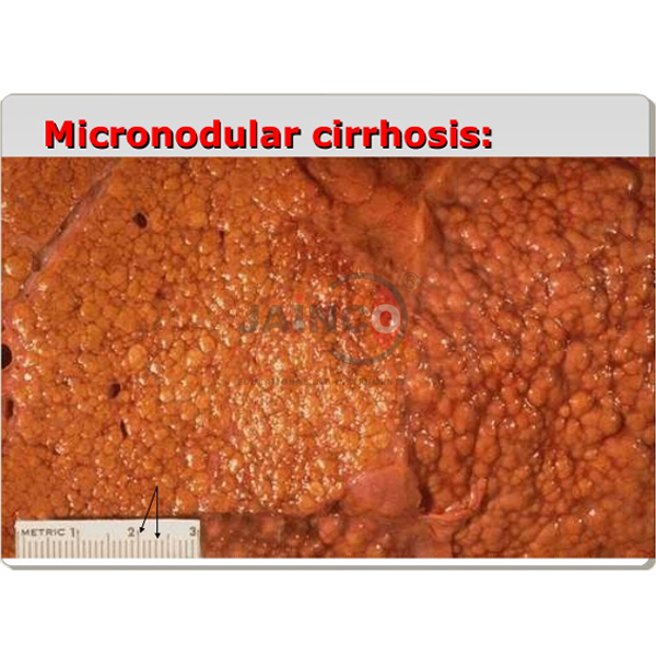 Micronodular Cirrhosis Model