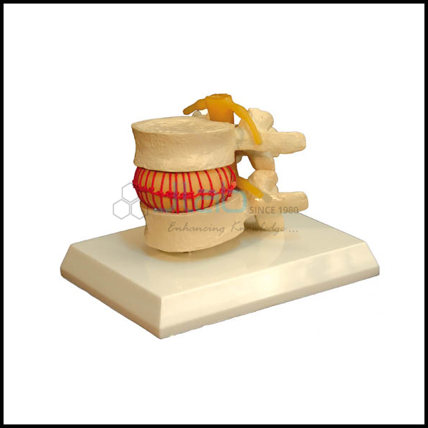 Disc Prolapse Simulator Model