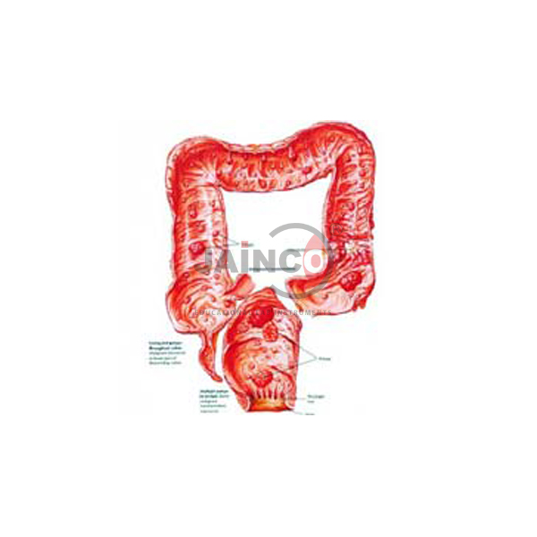 Familial Polyposis of Large Intestine Model
