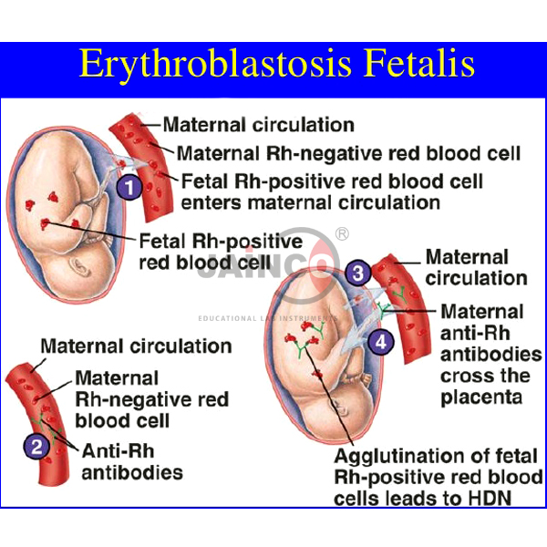 Erythroblastosis Fetalis Model