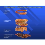 Clostridium Species and Summary of Disease Model